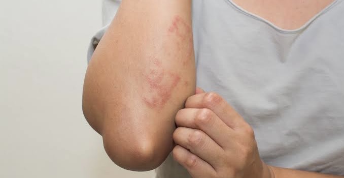 ALERGIA EMOCIONAL